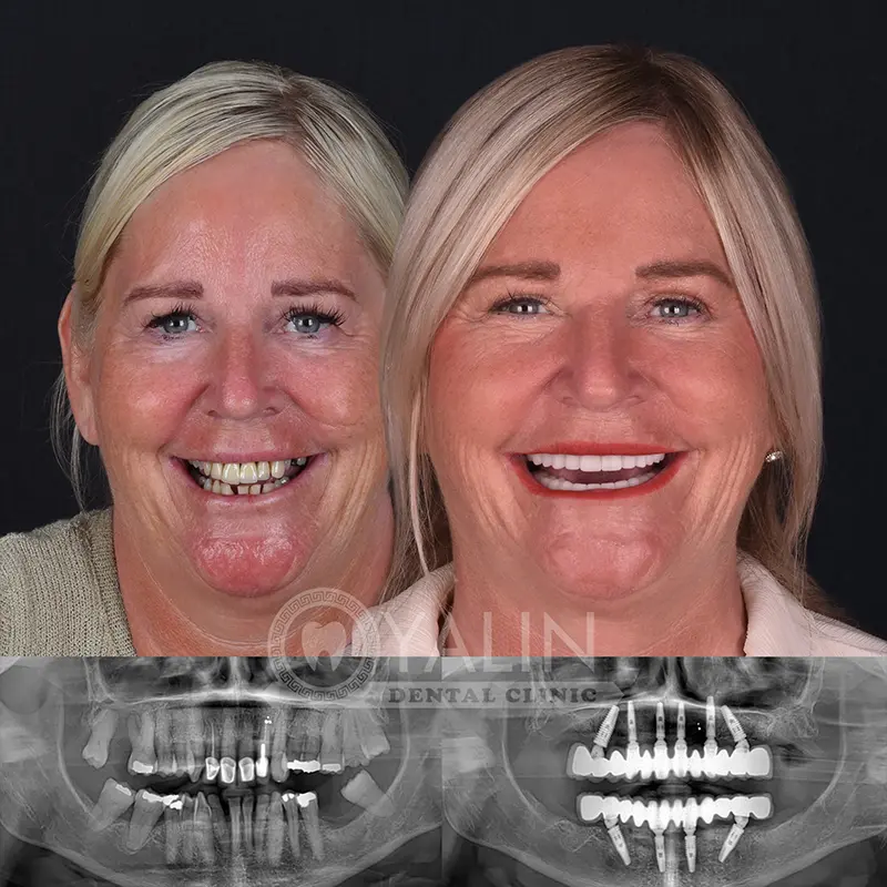 all-on-4, all-on-6-treatments, Yalindental Clinic