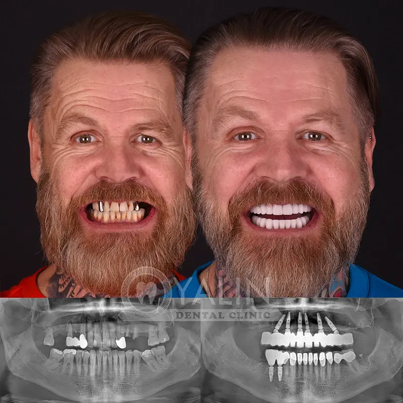 all-on-4, all-on-6-treatments, Yalindental Clinic