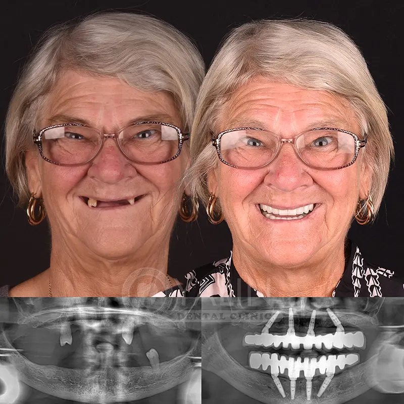 all-on-4, all-on-6-treatments, Yalindental Clinic