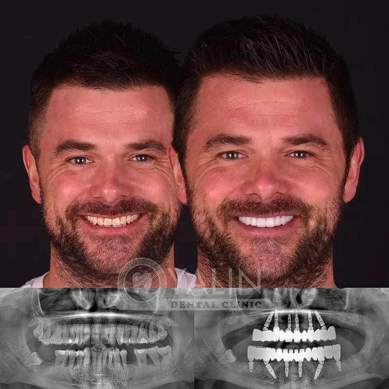 all-on-4, all-on-6-treatments, Yalindental Clinic
