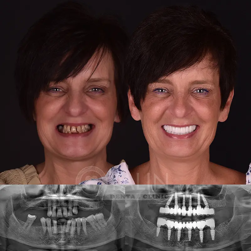 all-on-4, all-on-6-treatments, Yalindental Clinic
