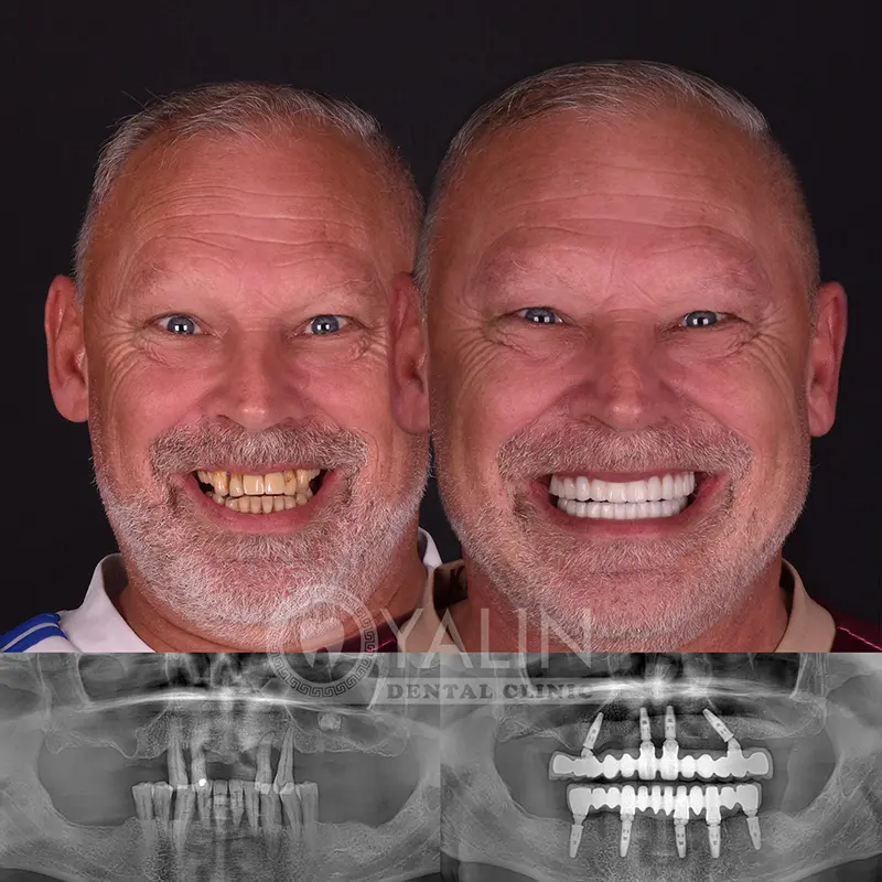 all-on-4, all-on-6-treatments, Yalindental Clinic