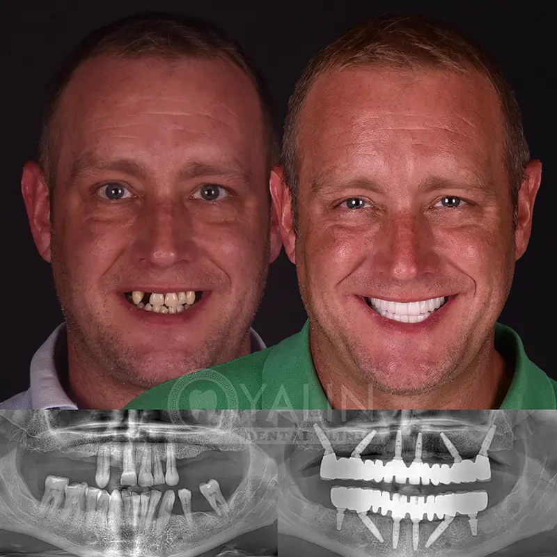 all-on-4, all-on-6-treatments, Yalindental Clinic
