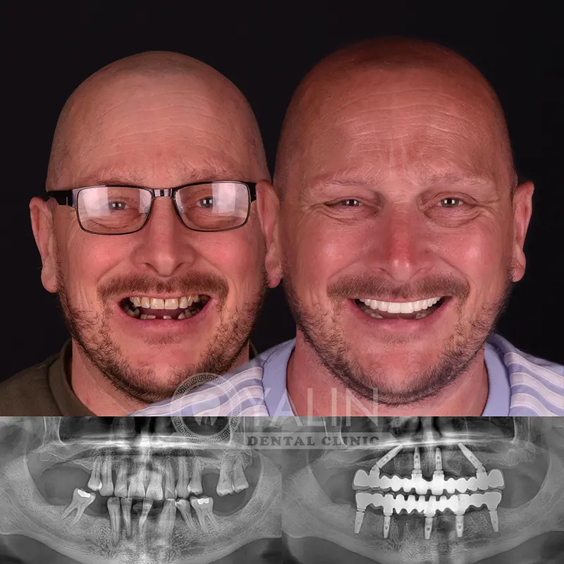 all-on-4, all-on-6-treatments, Yalindental Clinic