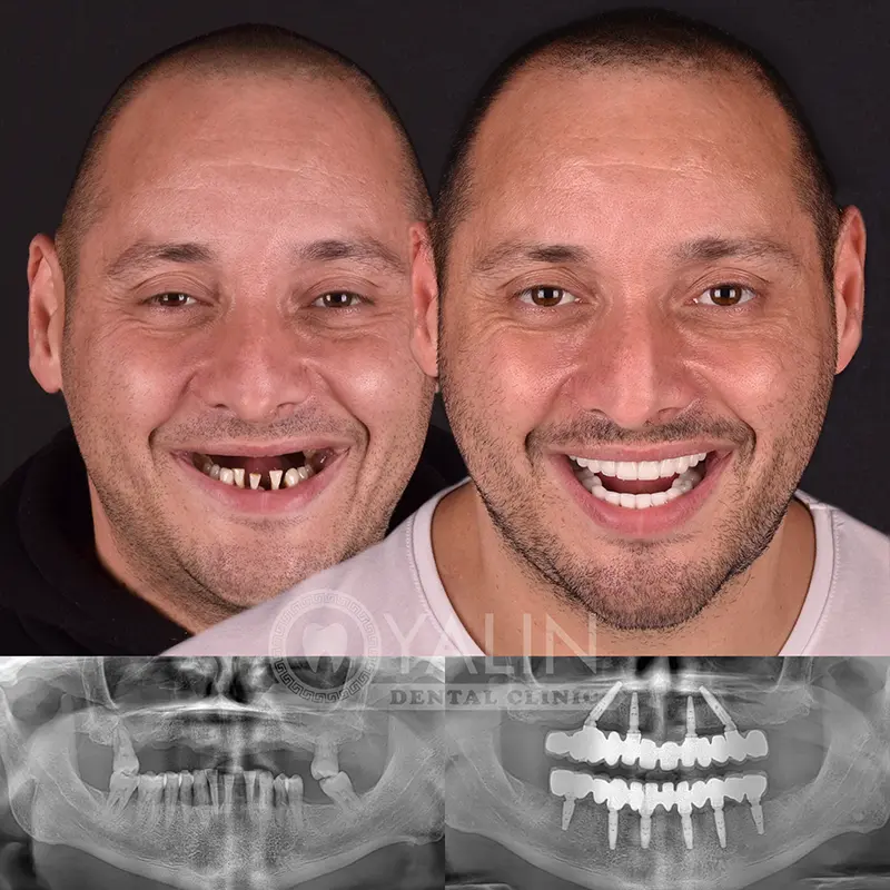 all-on-4, all-on-6-treatments, Yalindental Clinic
