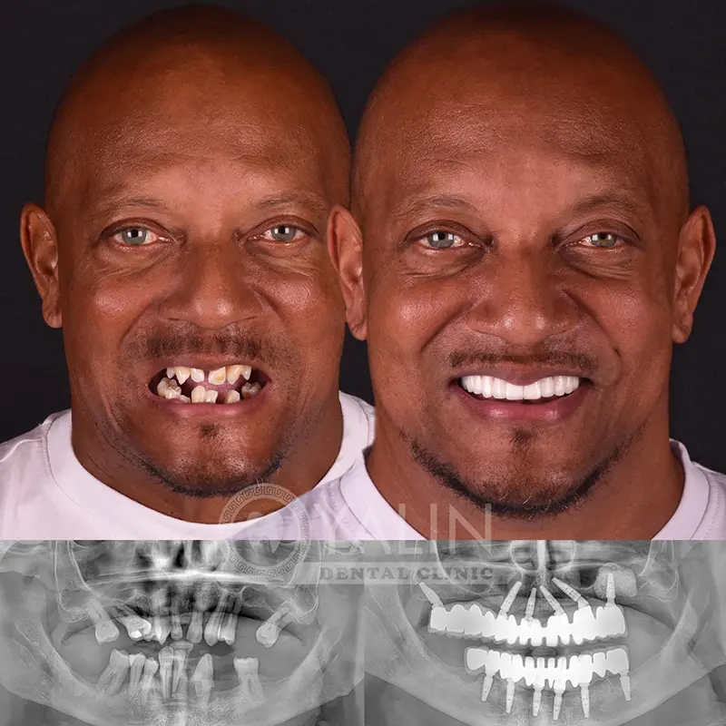all-on-4, all-on-6-treatments, Yalindental Clinic
