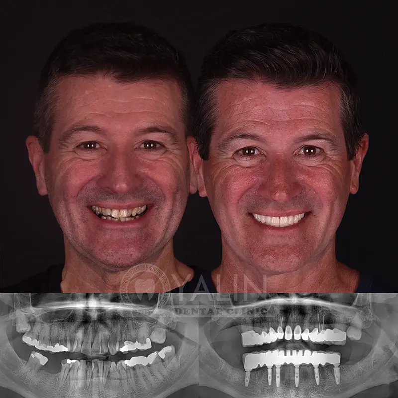 all-on-4, all-on-6-treatments, Yalindental Clinic