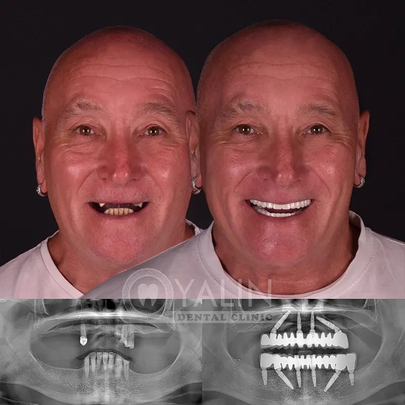 all-on-4, all-on-6-treatments, Yalindental Clinic