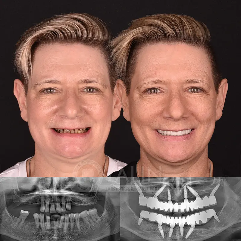 all-on-4, all-on-6-treatments, Yalindental Clinic
