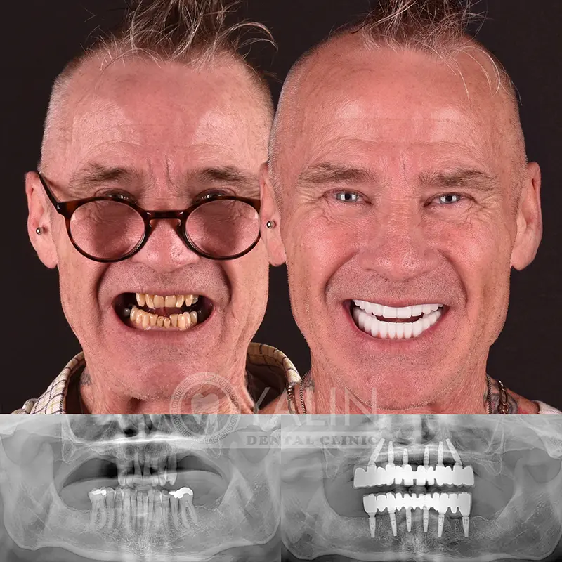 all-on-4, all-on-6-treatments, Yalindental Clinic