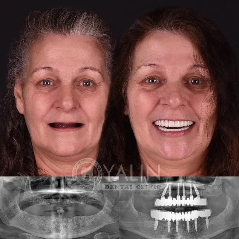 all-on-4, all-on-6-treatments, Yalindental Clinic