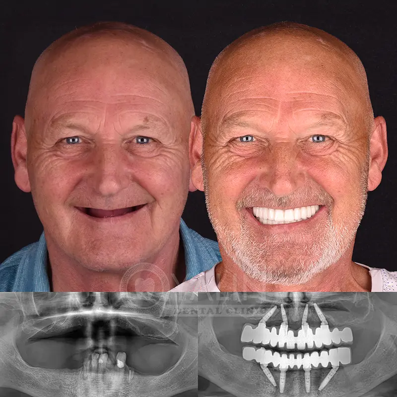 all-on-4, all-on-6-treatments, Yalindental Clinic