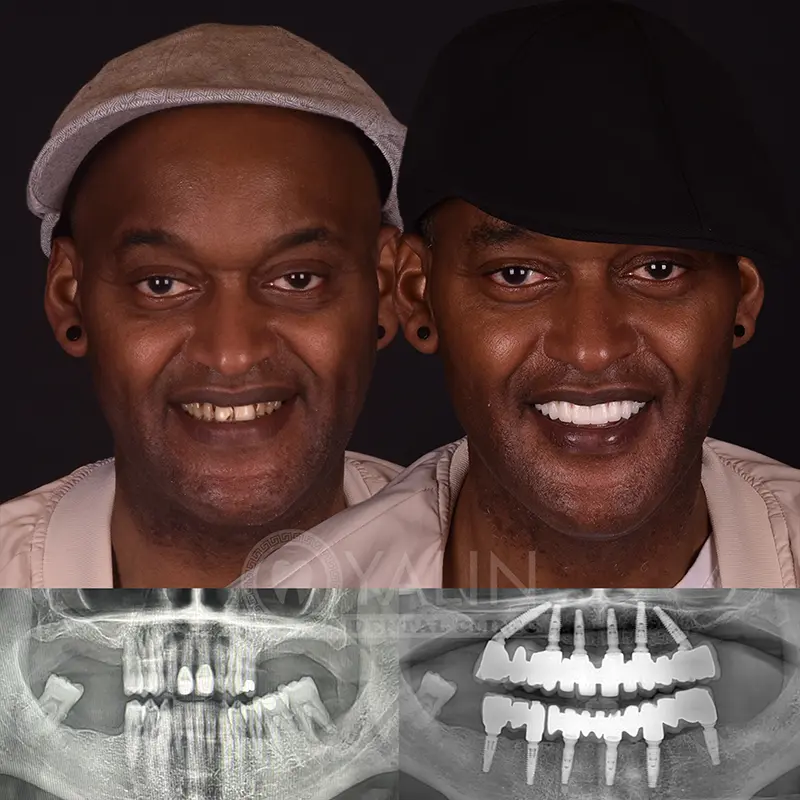 all-on-4, all-on-6-treatments, Yalindental Clinic