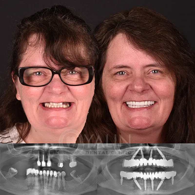 all-on-4, all-on-6-treatments, Yalindental Clinic