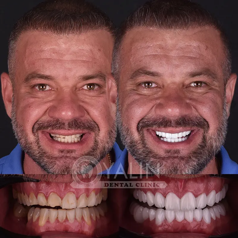 emax veneers in Turkey