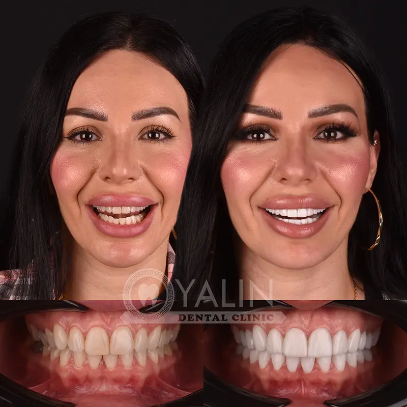 laminate veneers in Turkey