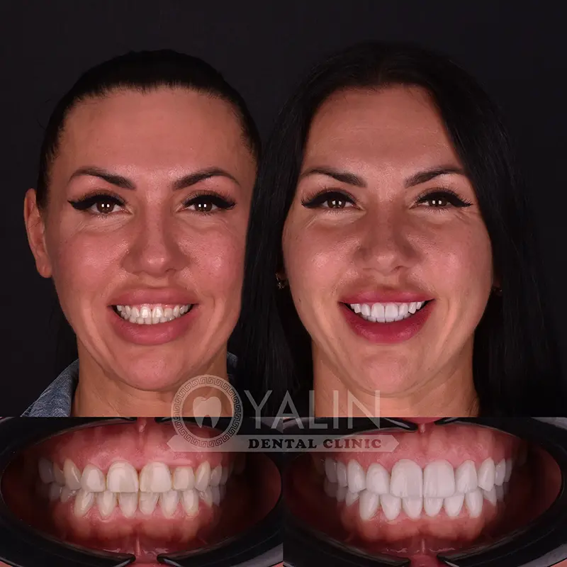 laminate veneers in Turkey