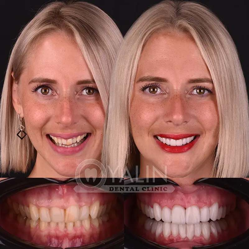Hollywood smile in Turkey