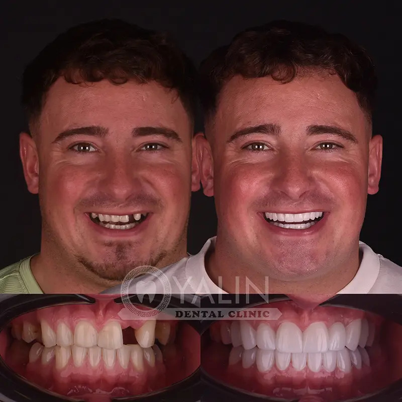 Hollywood smile in Turkey