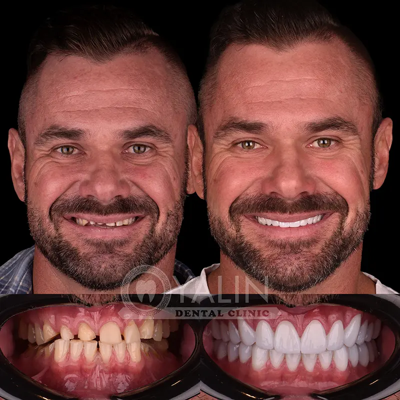 Hollywood smile in Turkey