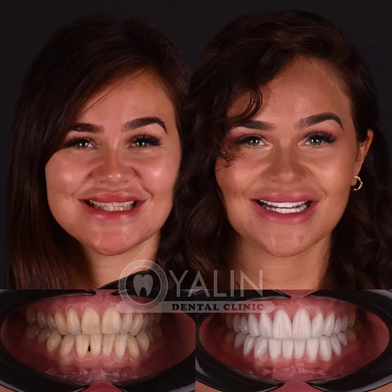 Hollywood smile in Turkey