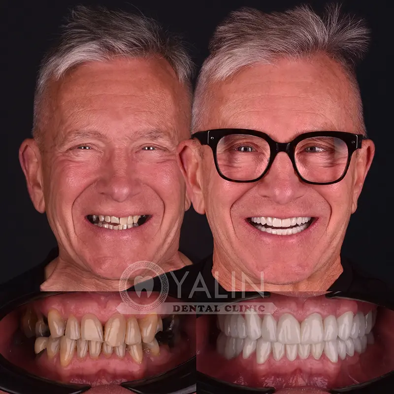 Hollywood smile in Turkey