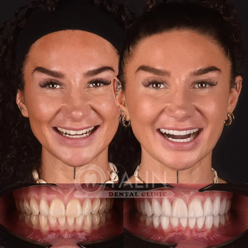 Hollywood smile in Turkey