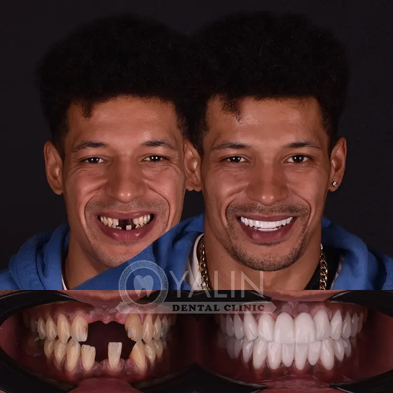 Hollywood smile in Turkey