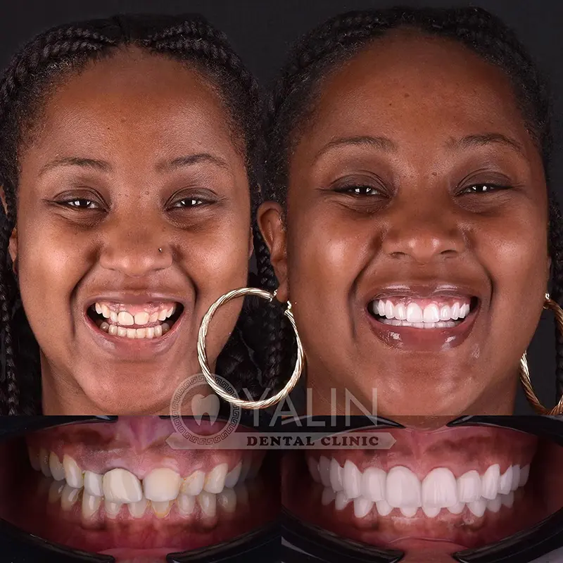 Hollywood smile in Turkey
