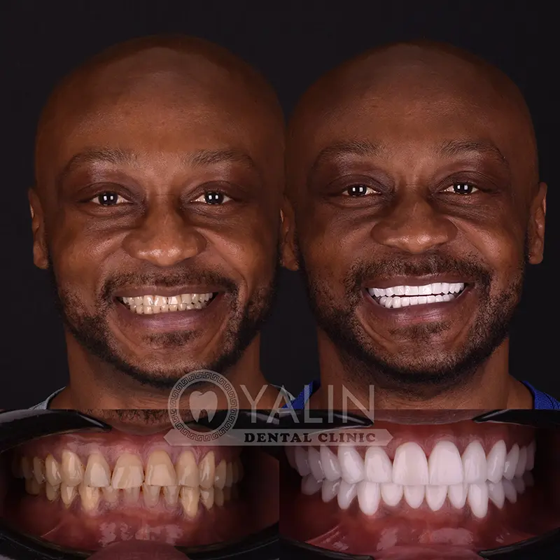 Hollywood smile in Turkey