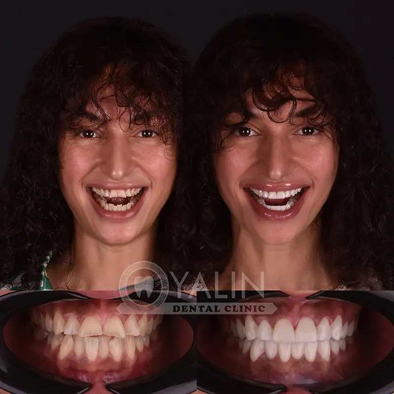 Hollywood smile in Turkey