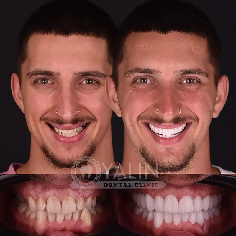 Yalındental Clinic, Zirconium crown